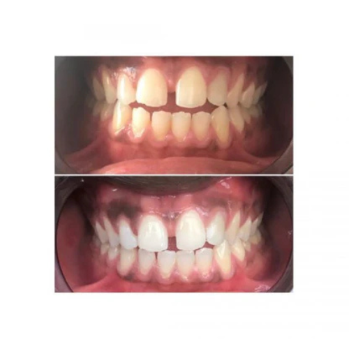 Dentifrice Charbon Actif Blanchissant