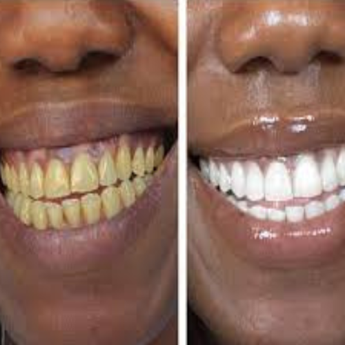 Dentifrice Charbon Actif Blanchissant